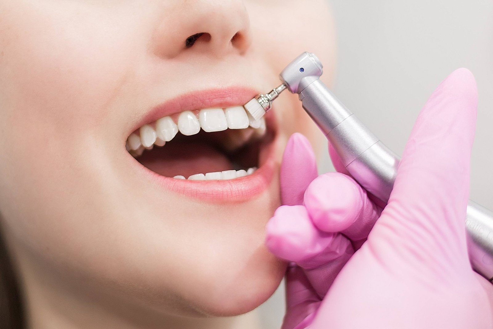 Teeth whitening